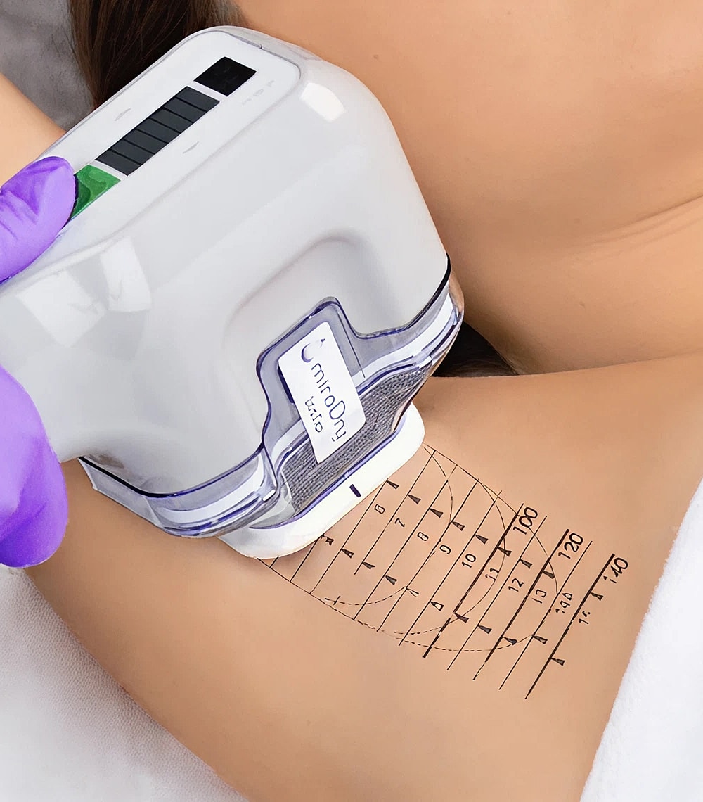 Laser hair removal treatment in progress.