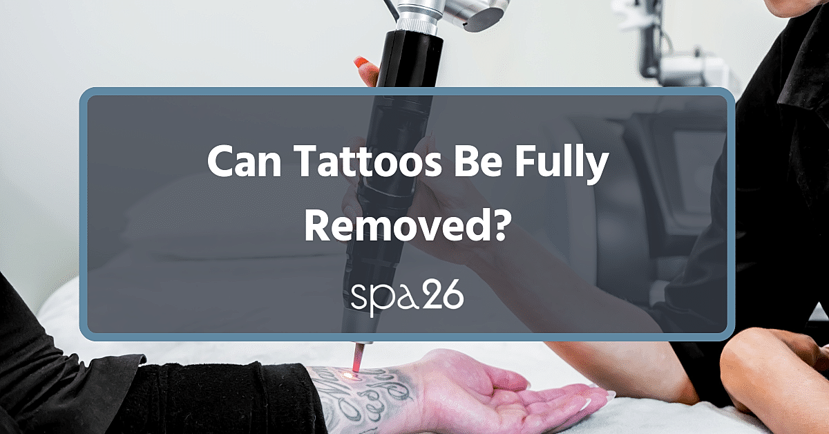 Can Tattoos Be Fully Removed?