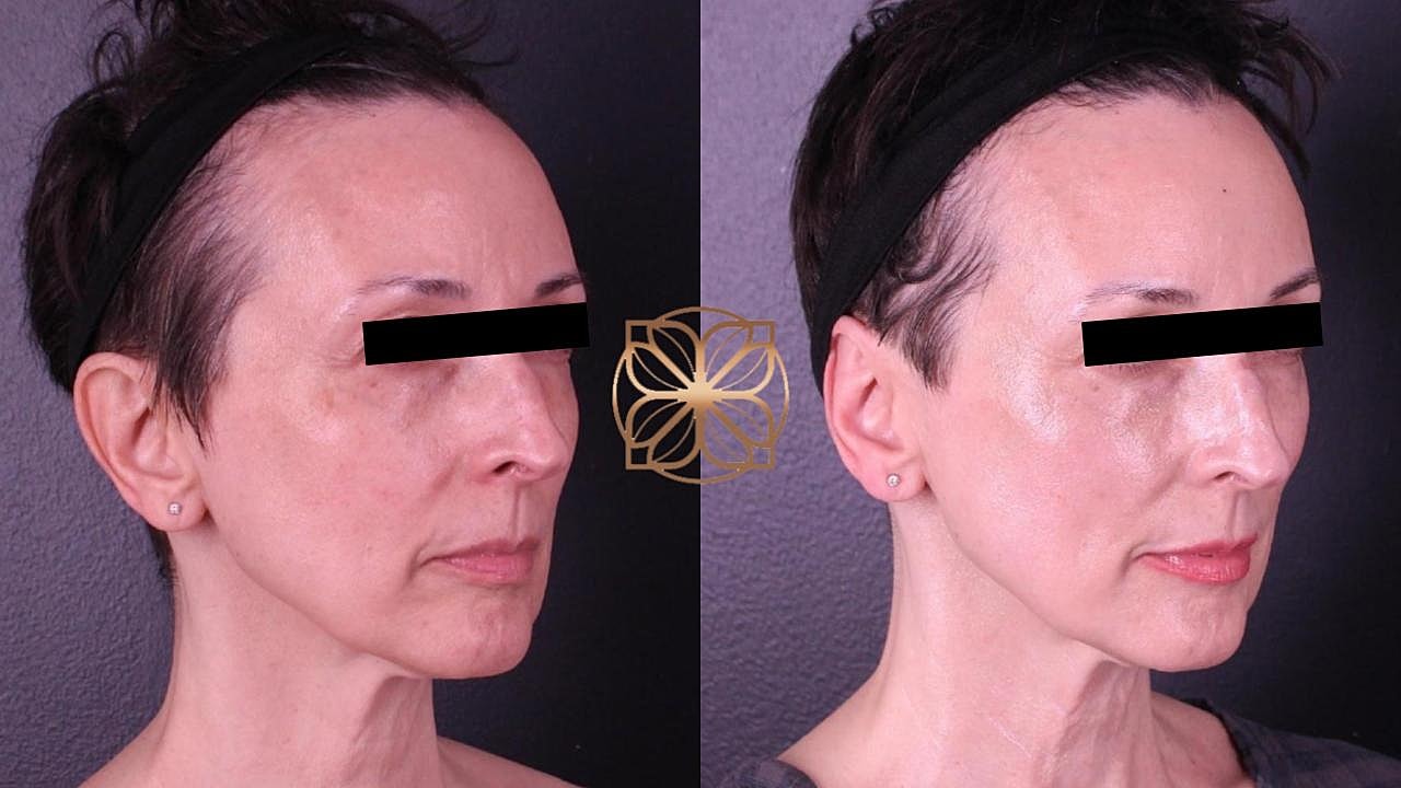 Before and after facial transformation comparison.