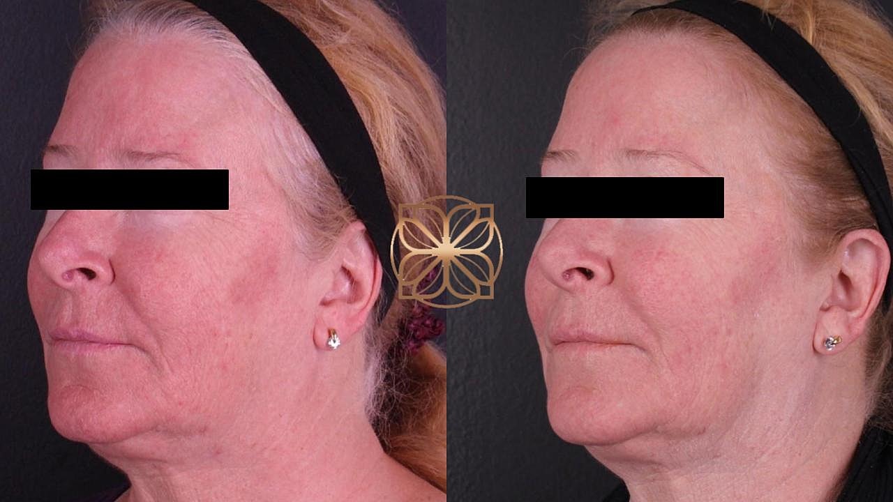 Before and after facial treatment comparison.