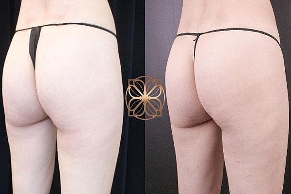 Model in thong, showcasing rear view.