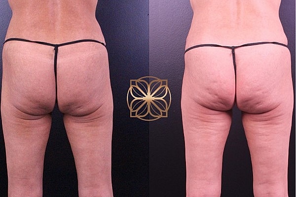 Before and after body contouring comparison.