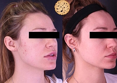 Before and after skin treatment comparison photo.
