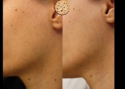 Comparison of skin textures before and after treatment