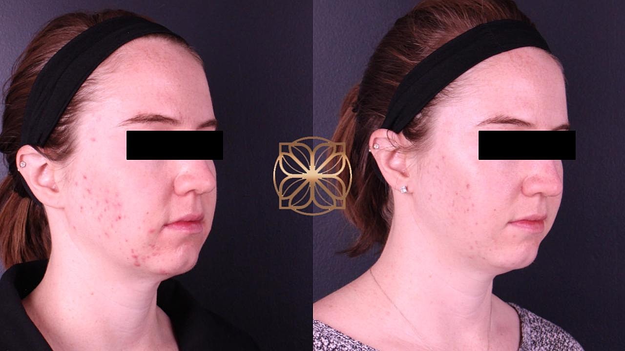 Before and after skincare treatment results.