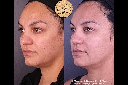 Before and after skincare treatment comparison.