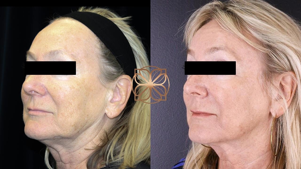 Before and after facial rejuvenation treatment comparison.