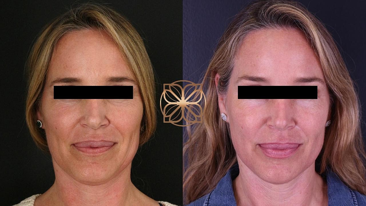 Before and after facial treatment comparison.