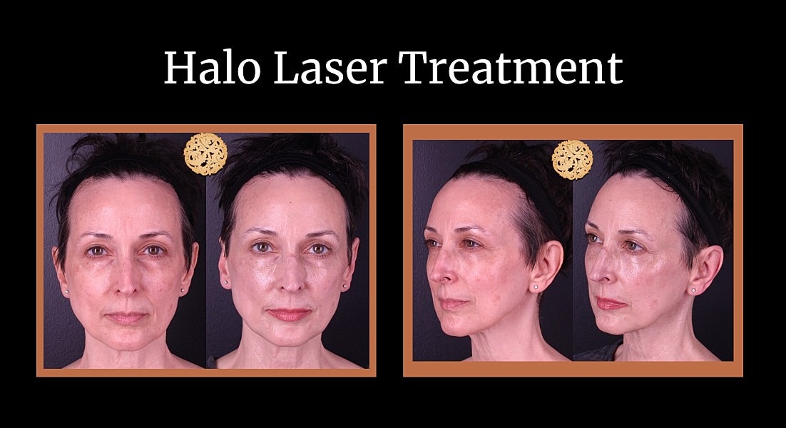 Before and after facelift and eyelid surgery.