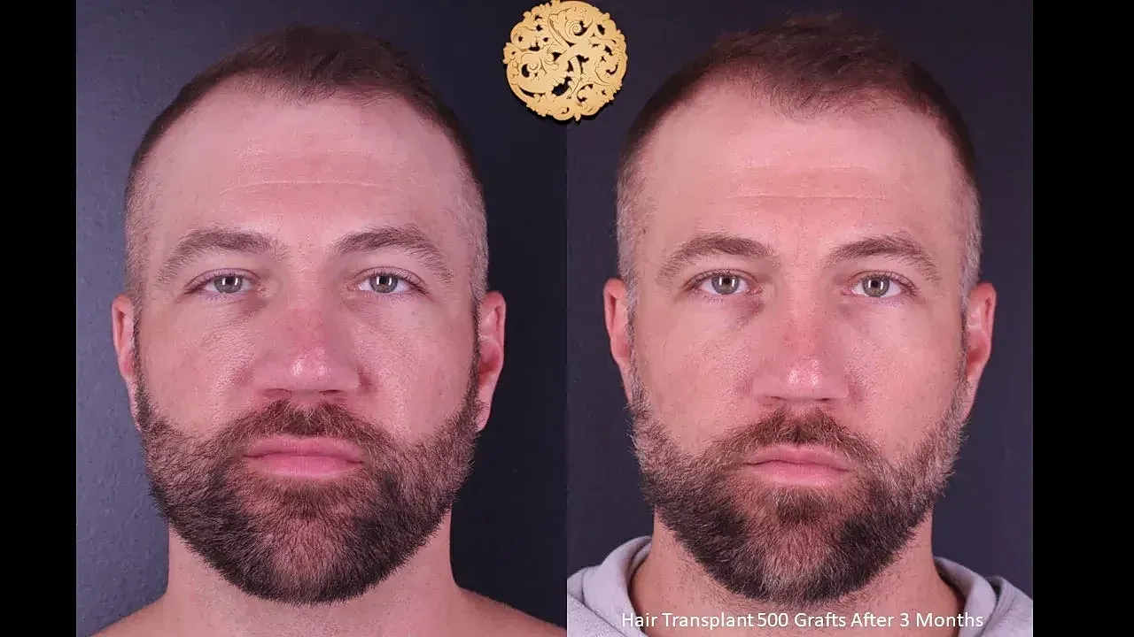 Before and after hair transplant progress.