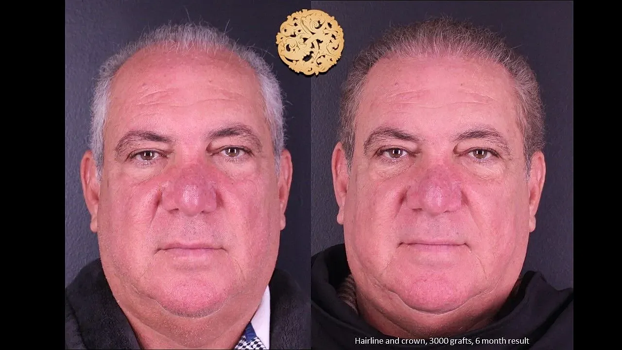 Before and after hair restoration comparison photo.