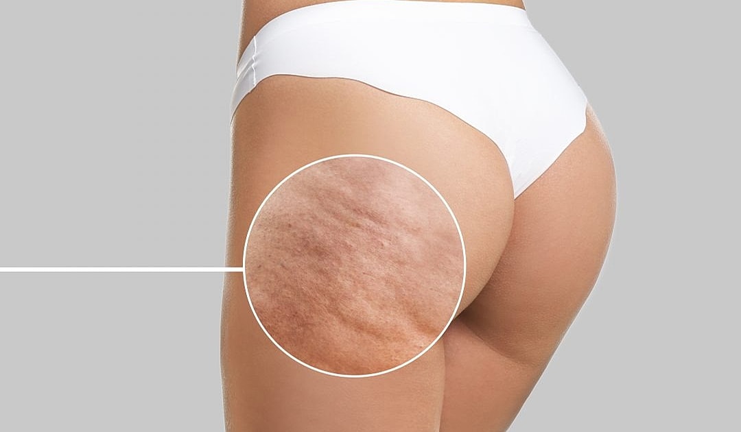 Close-up of skin texture on thigh and buttocks.