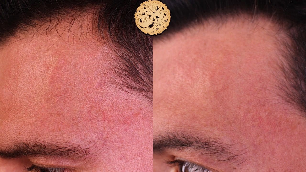 Comparison of skin texture before and after treatment.