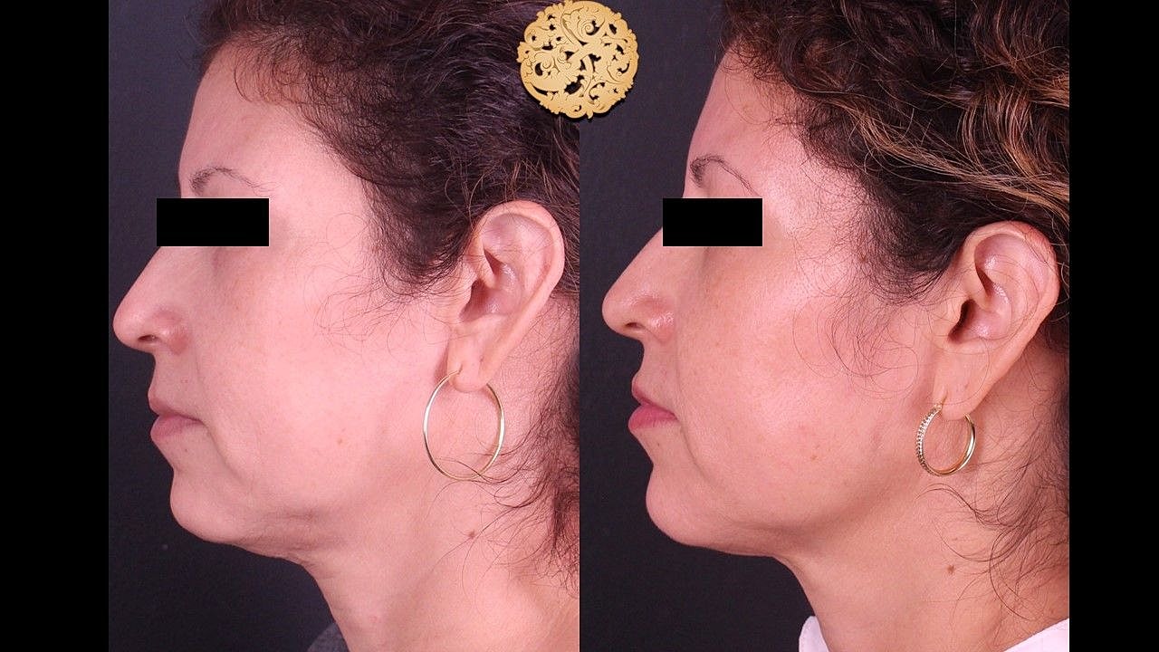 Before and after facial profile comparison.
