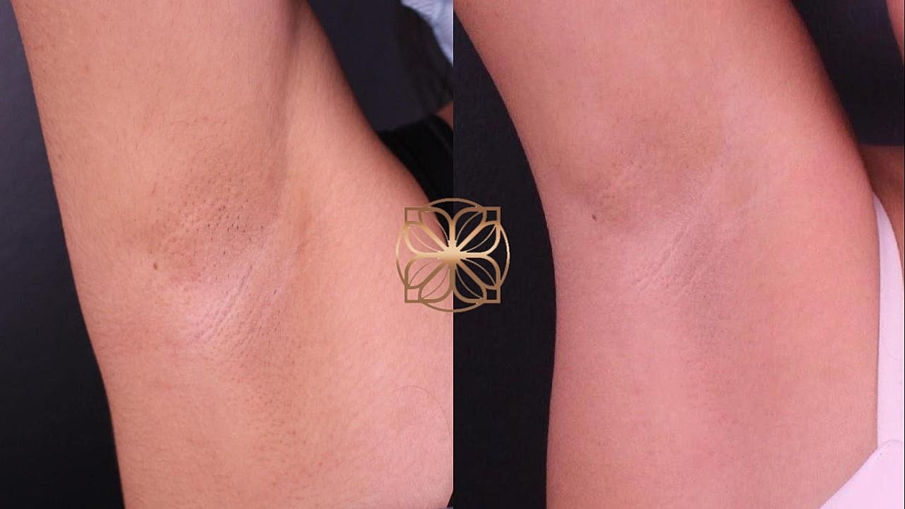 Before and after skin treatment comparison.