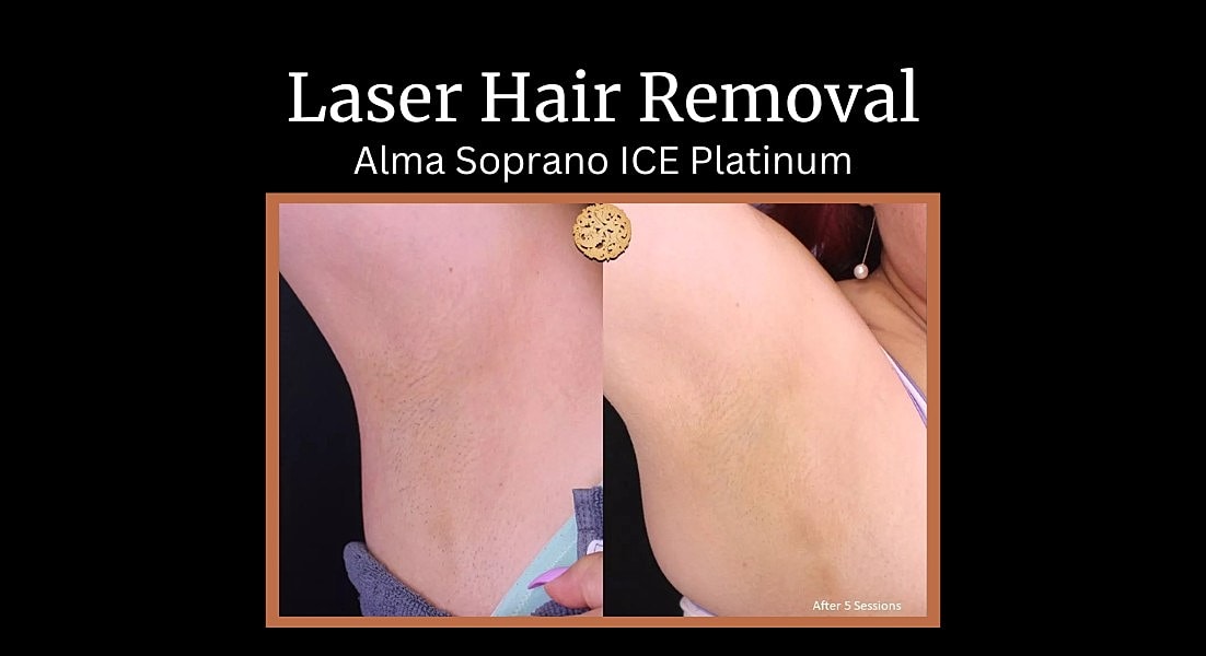 Before and after facelift and eyelid surgery.