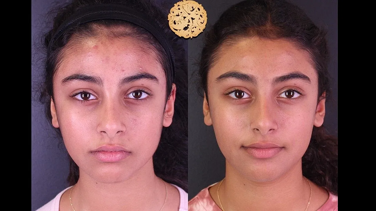Before and after skincare treatment comparison.