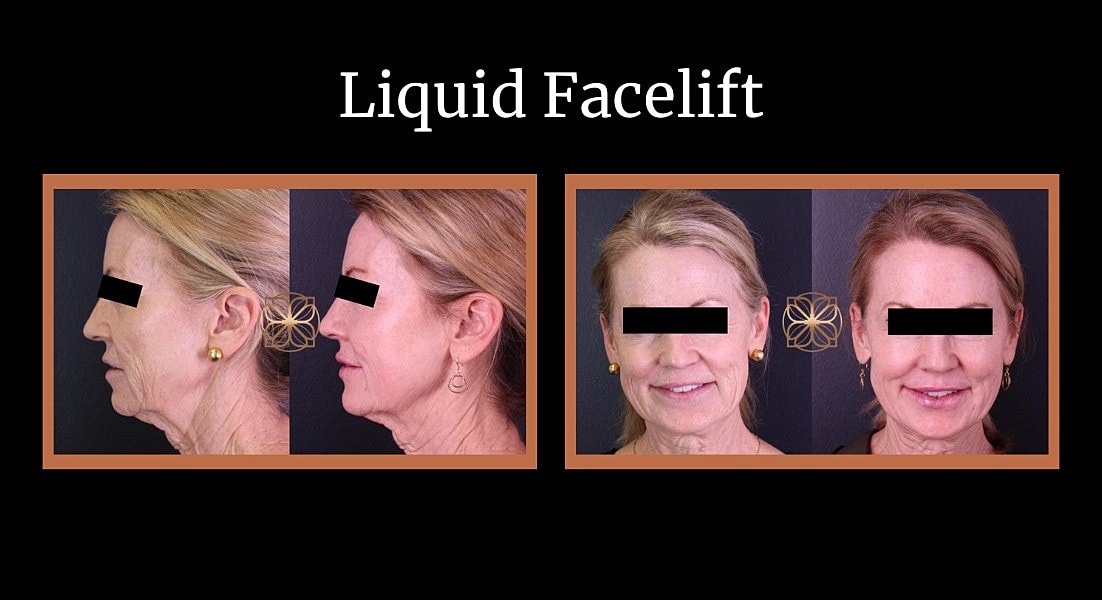 Before and after facelift comparison photo.