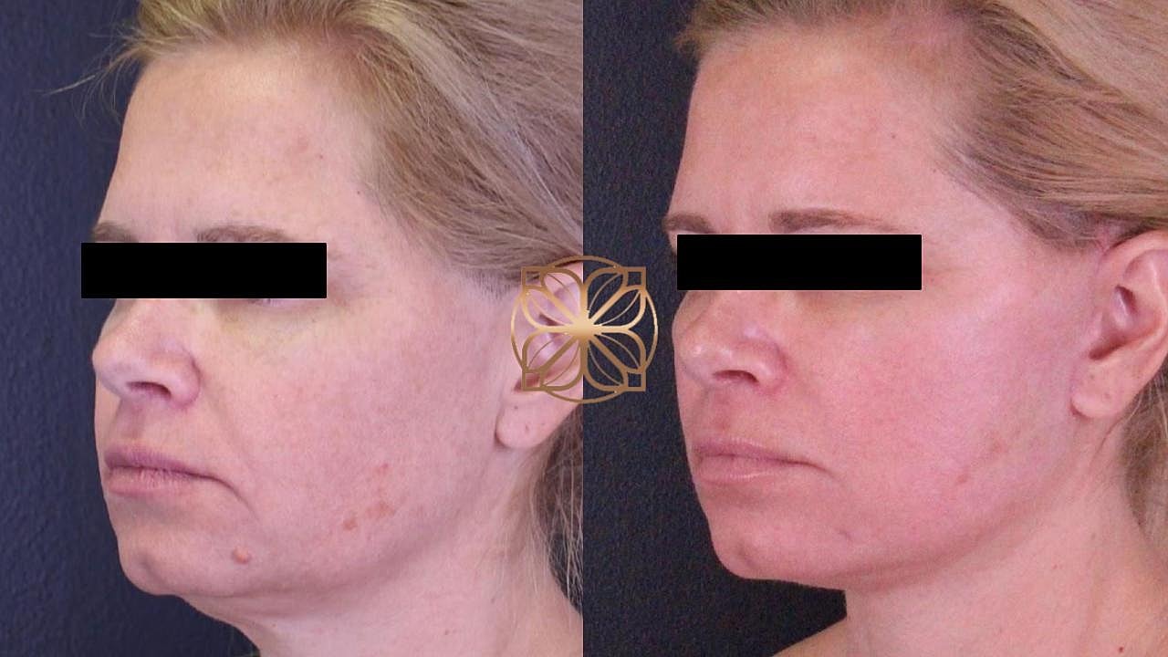 Before and after facial treatment comparison side profile.