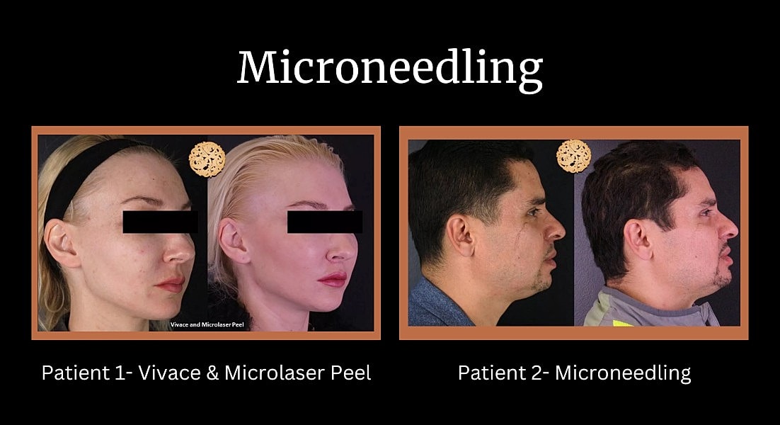 Before and after facelift comparison photo.