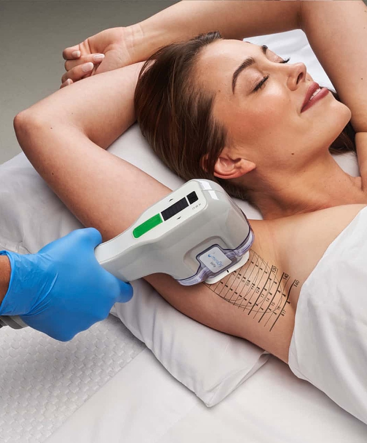 Laser treatment for underarm hair removal procedure.