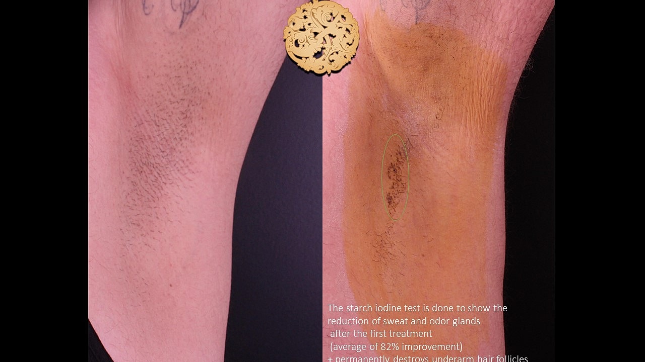 Before and after results of underarm treatment.