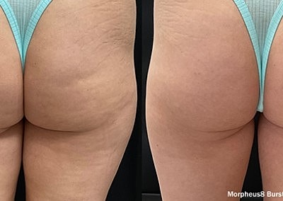 Before and after body contouring treatment results.