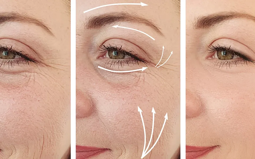 Eye treatment before and after with directional arrows.