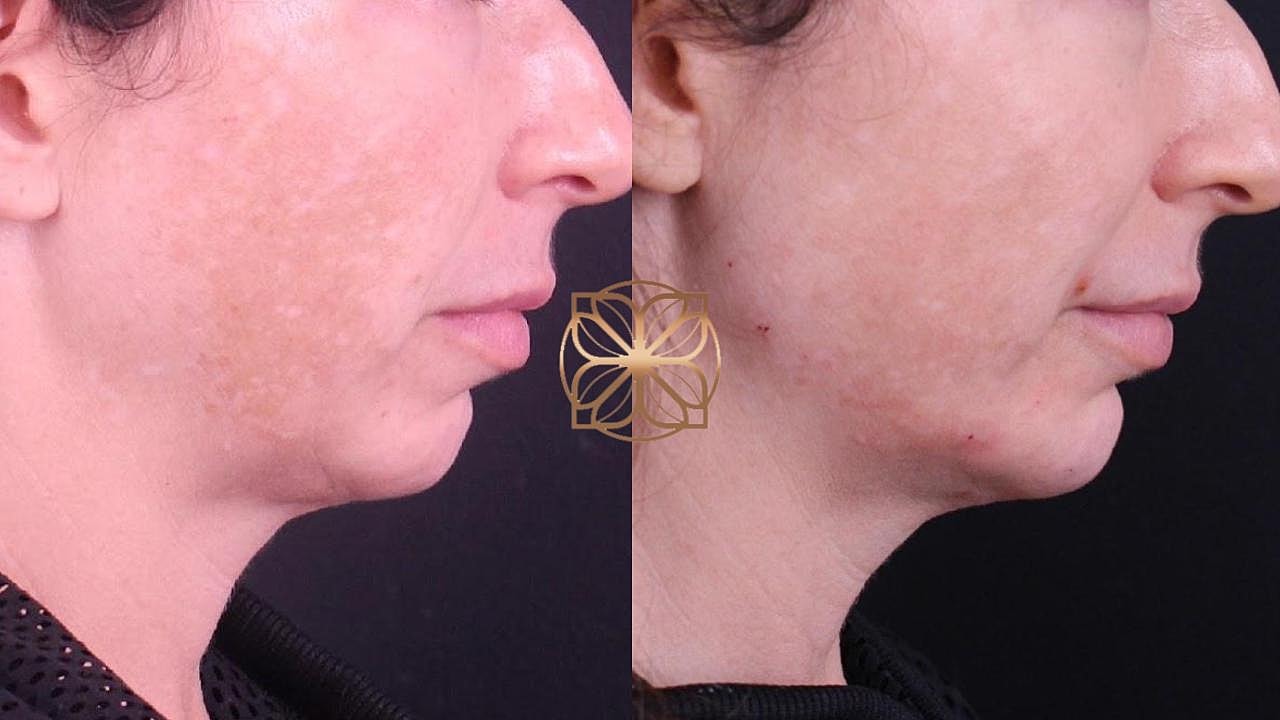 Before and after skin treatment comparison image.