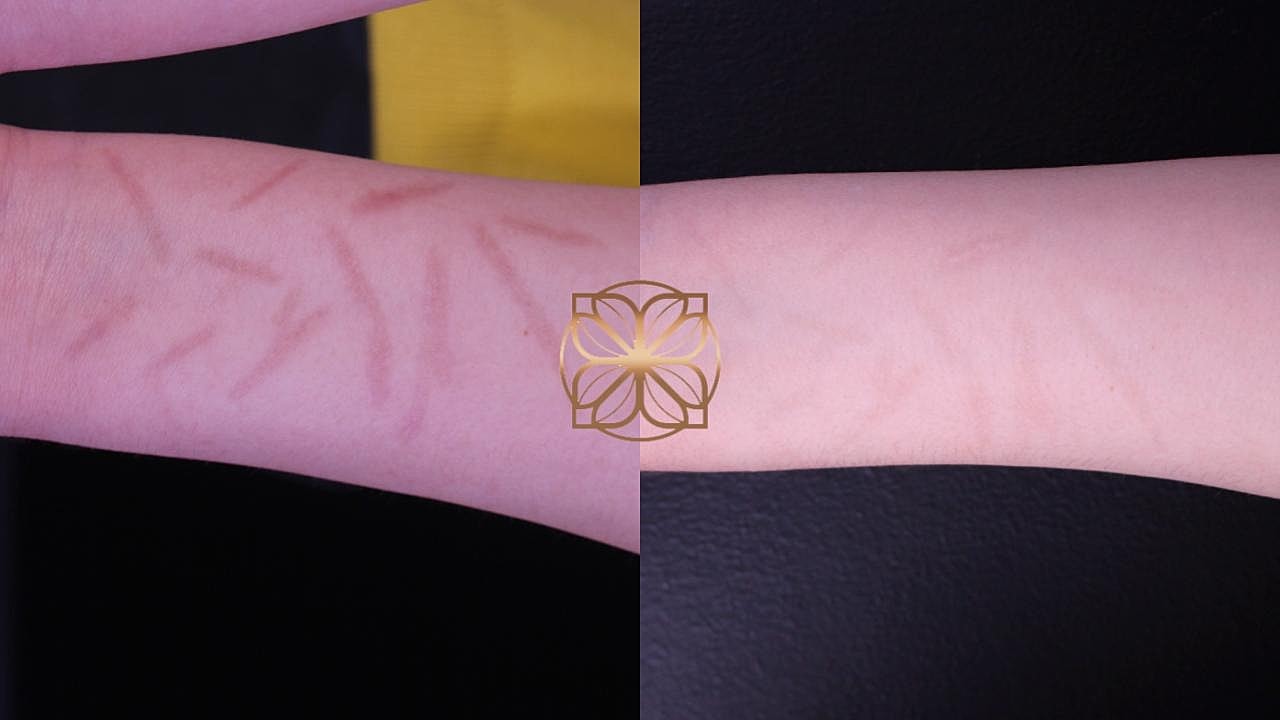 Comparison of skin markings on two arms.