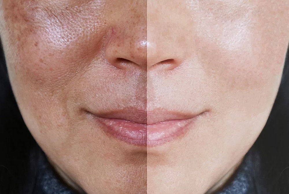 Before and after skin treatment comparison.