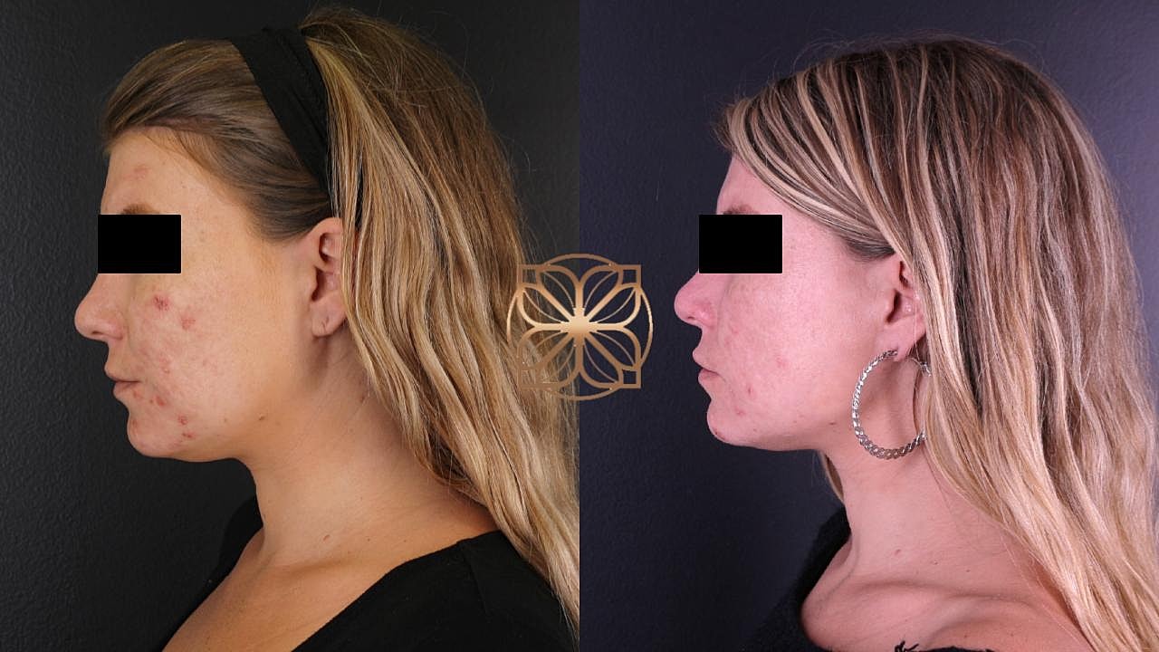 Before and after skin treatment comparison image.