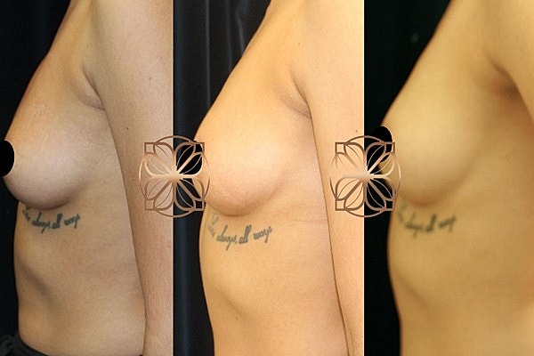 Before and after breast enhancement comparison image.