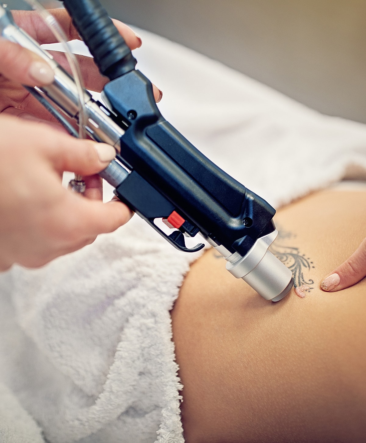 Tattoo removal procedure in progress on skin.