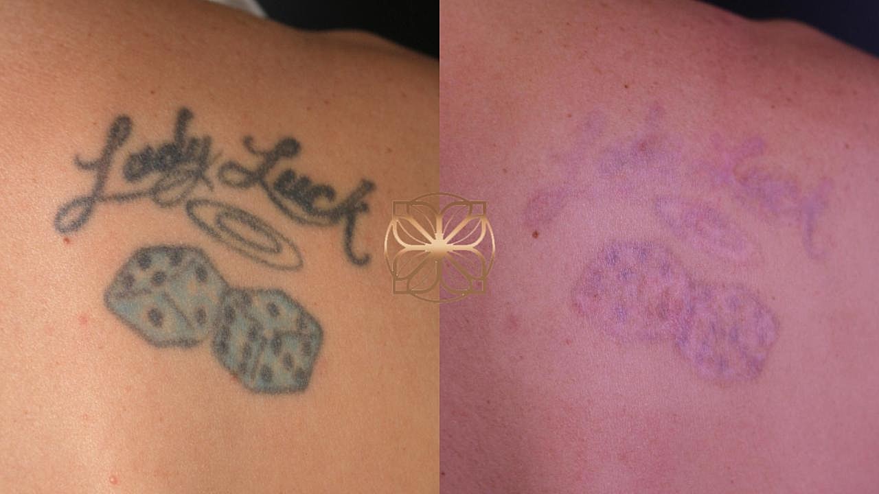 Before and after tattoo fading comparison.