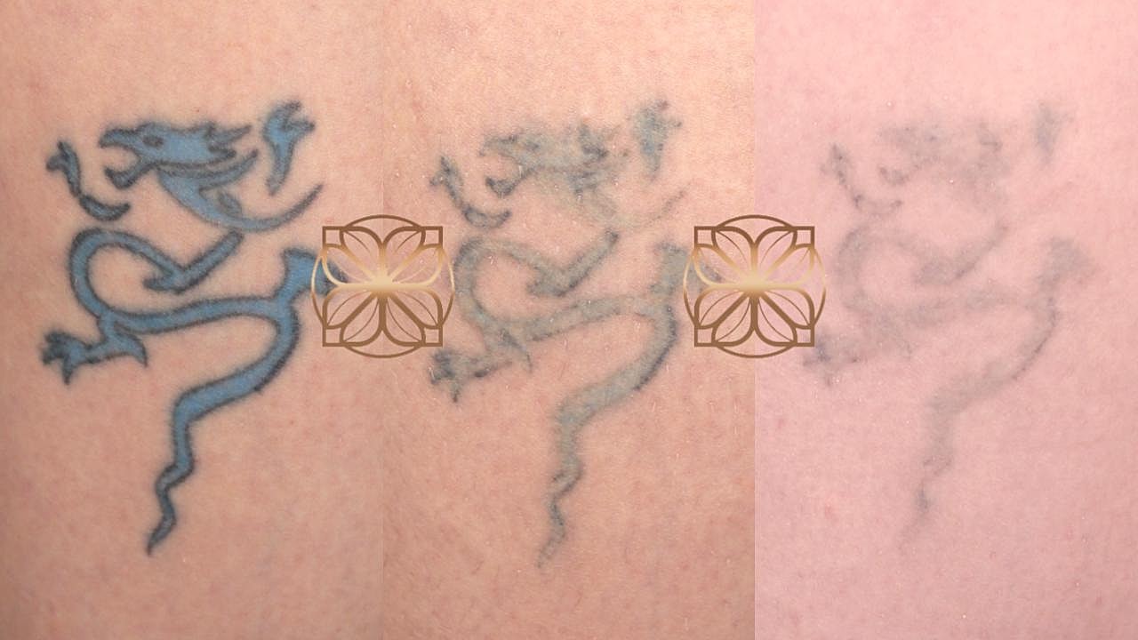 Dragon tattoo in various fading stages.