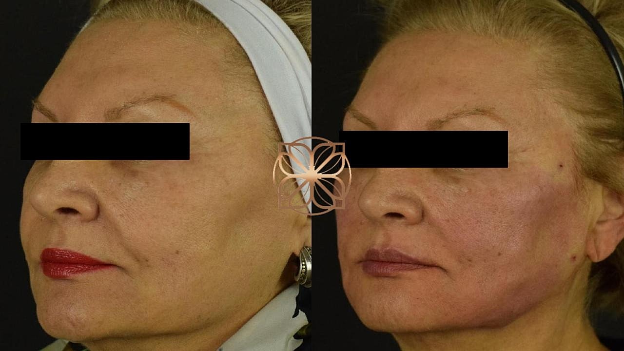 Before and after cosmetic treatment comparison.