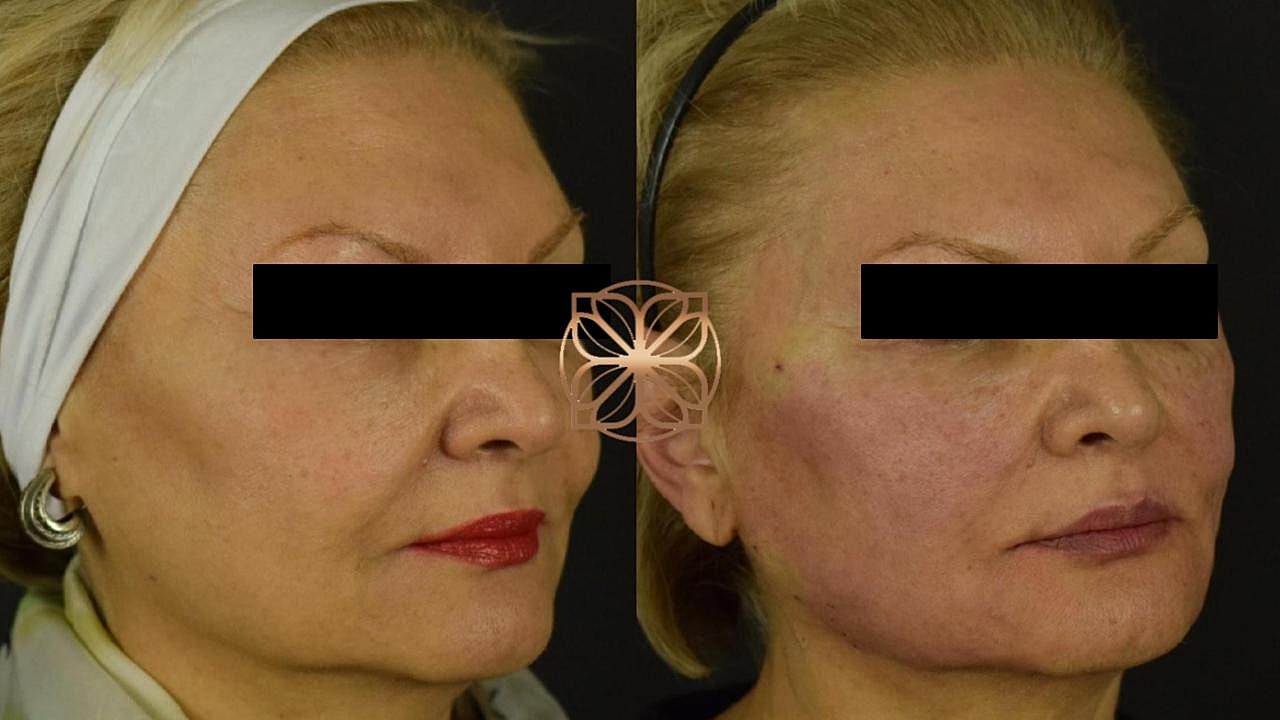 Before and after facial treatment comparison.