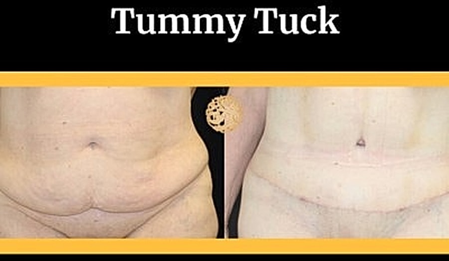 Before and after tummy tuck transformation.