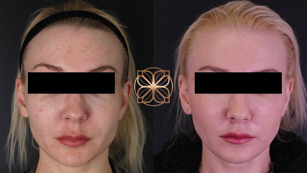 Before and after facial transformation comparison.