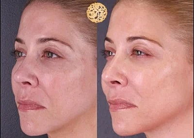 Before and after skin treatment comparison.