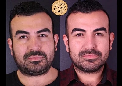Before and after facial transformation photos.