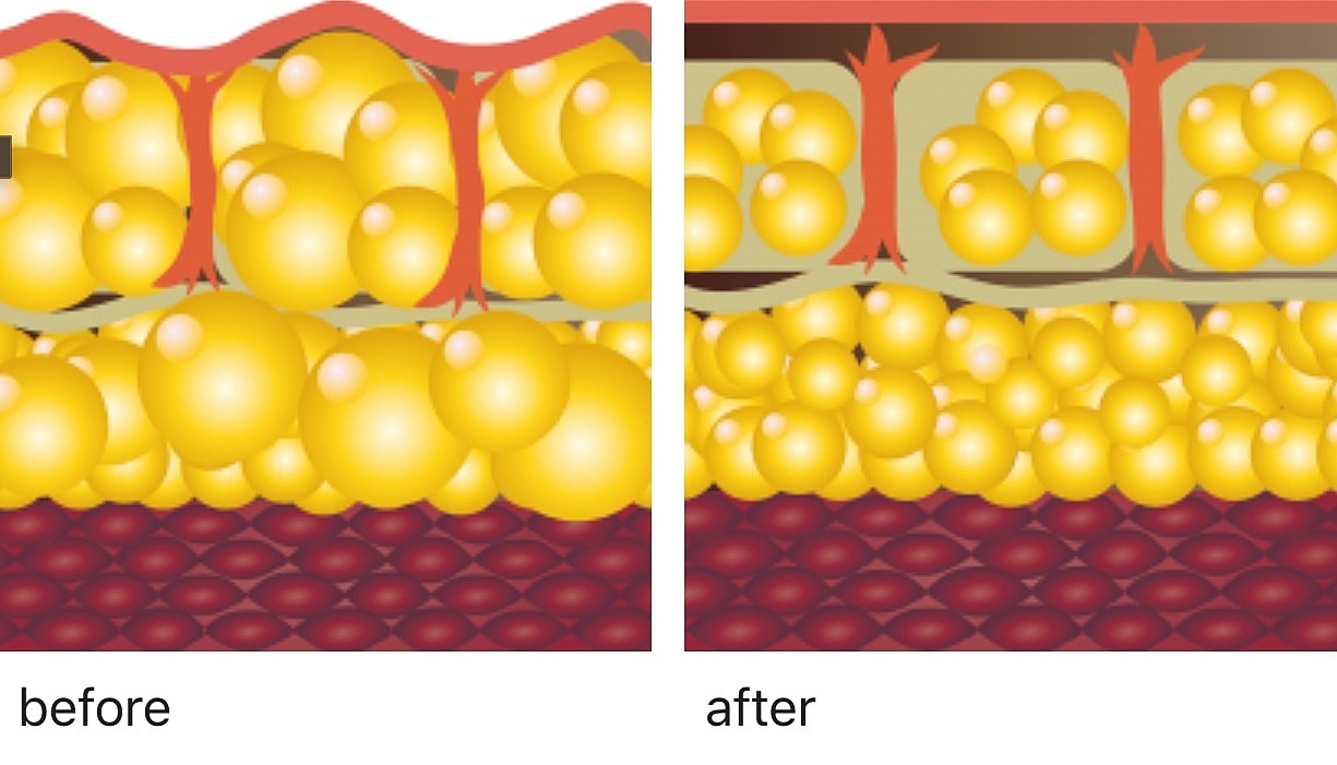 Fat cell comparison: before and after treatment.