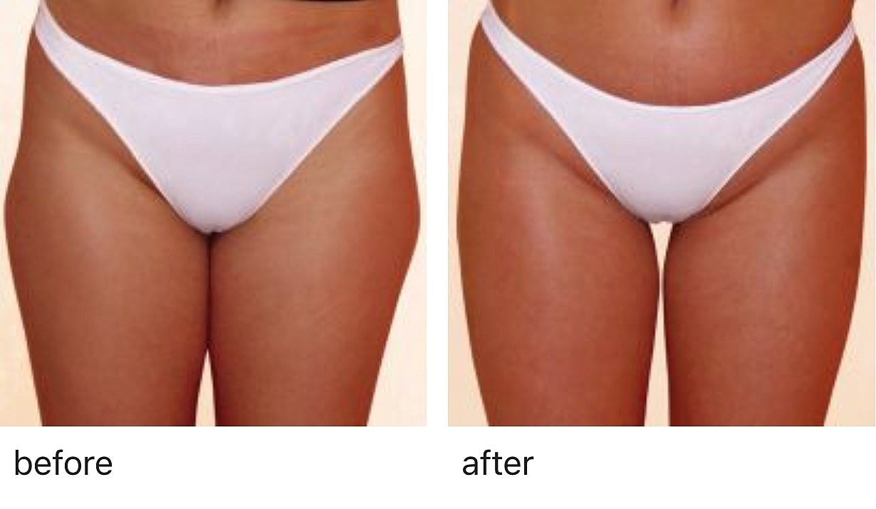 Before and after body image comparison.