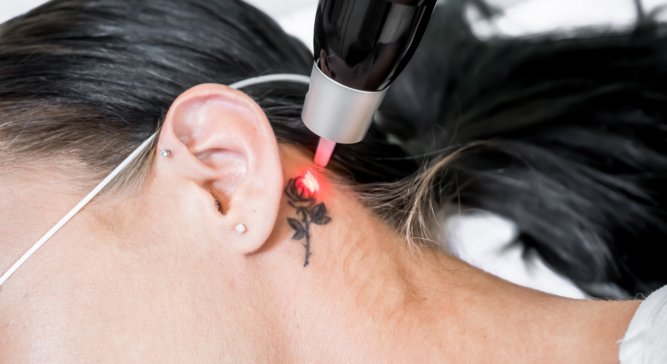 Laser tattoo removal in progress on ear.